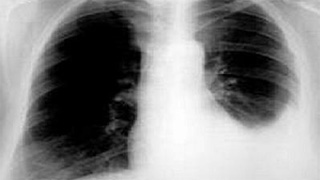 Những điều cần biết về tràn dịch màng phổi